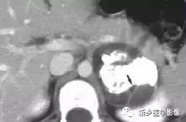 18种胰腺肿瘤，为什么我就知道两种