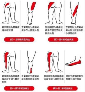 腰椎间盘突出腰腿痛平时锻炼方法,腰椎间盘突出脚麻疼痛怎么缓解