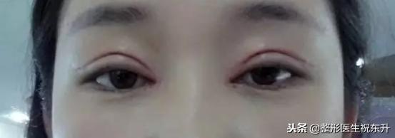 单眼皮与双眼皮的优缺点,欧式双眼皮有什么优缺点