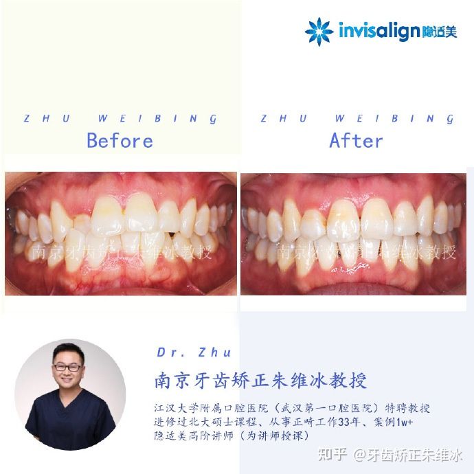 南京牙齿矫正骨性嘴凸案例,郑州牙齿矫正会让脸型更好看吗