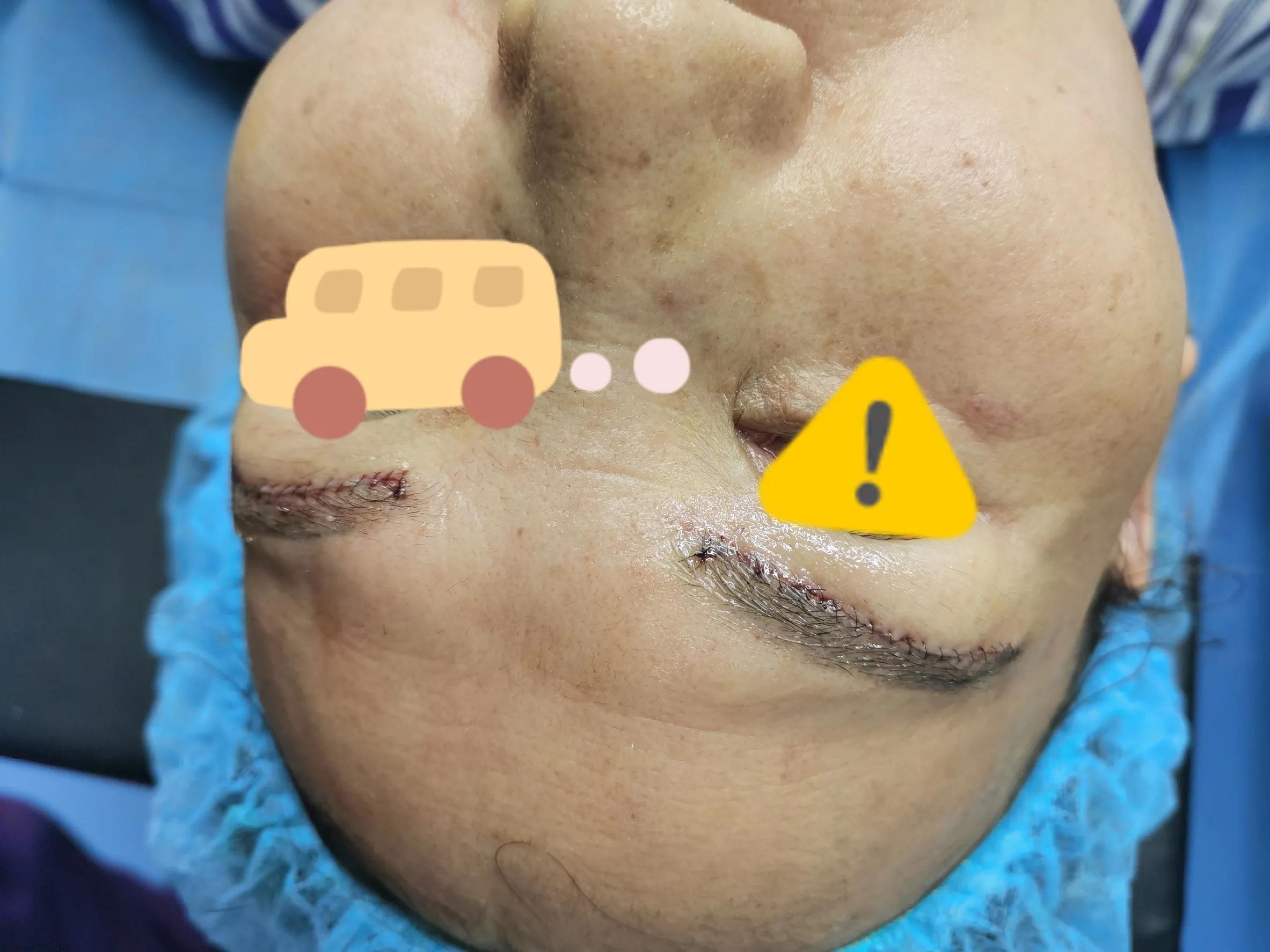 整形手术除皱会反弹吗,整形手术会不会有后遗症