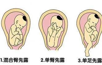 关于孩子胎位,胎位正的叫什么