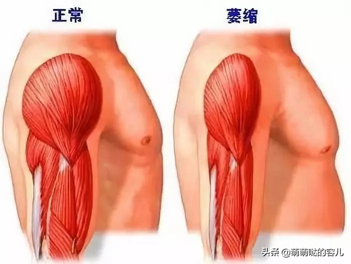 什么是肌肉萎缩症如何治疗,什么是肌肉萎缩综合征