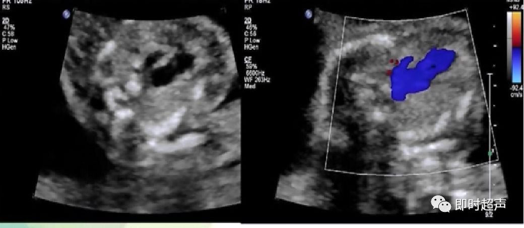 胎儿心脏三种血管关系模式图,25周的胎儿心脏弓切面多少正常