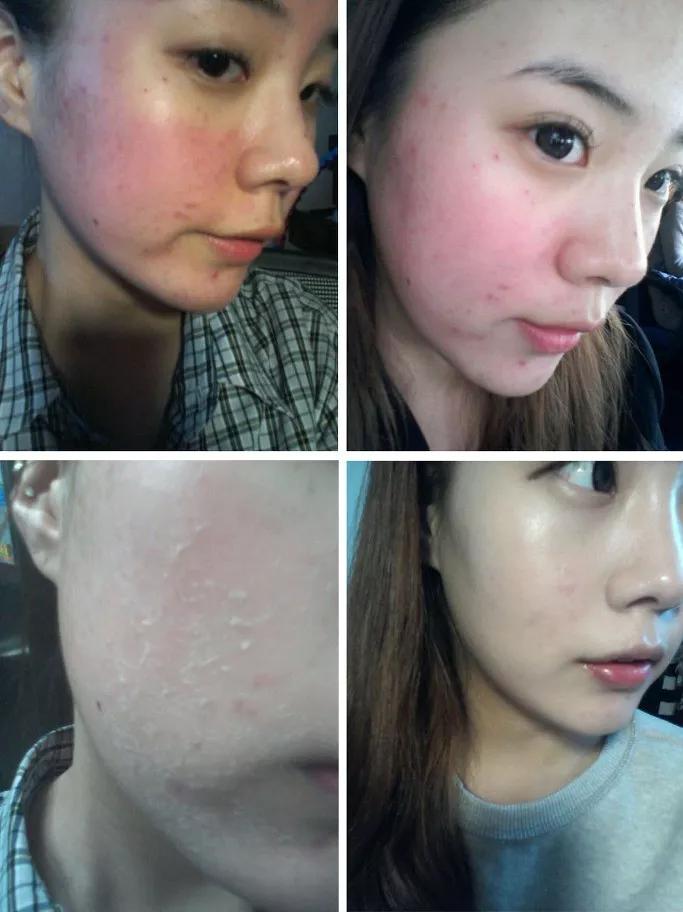 盘点秋冬轻医美项目TOP5