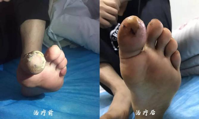 北京国康医院刘教授中医综合治疗势如破竹脉管炎患者康复出院