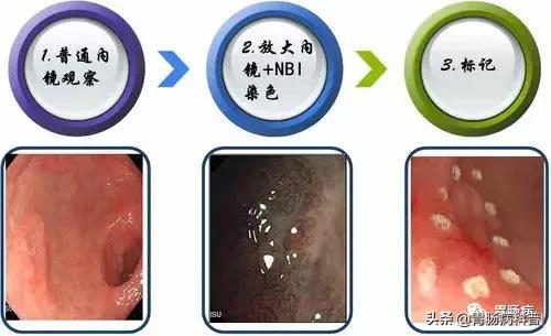 内镜下粘膜剥离术属于esd还是emr,胃肠息肉内镜下黏膜剥离术
