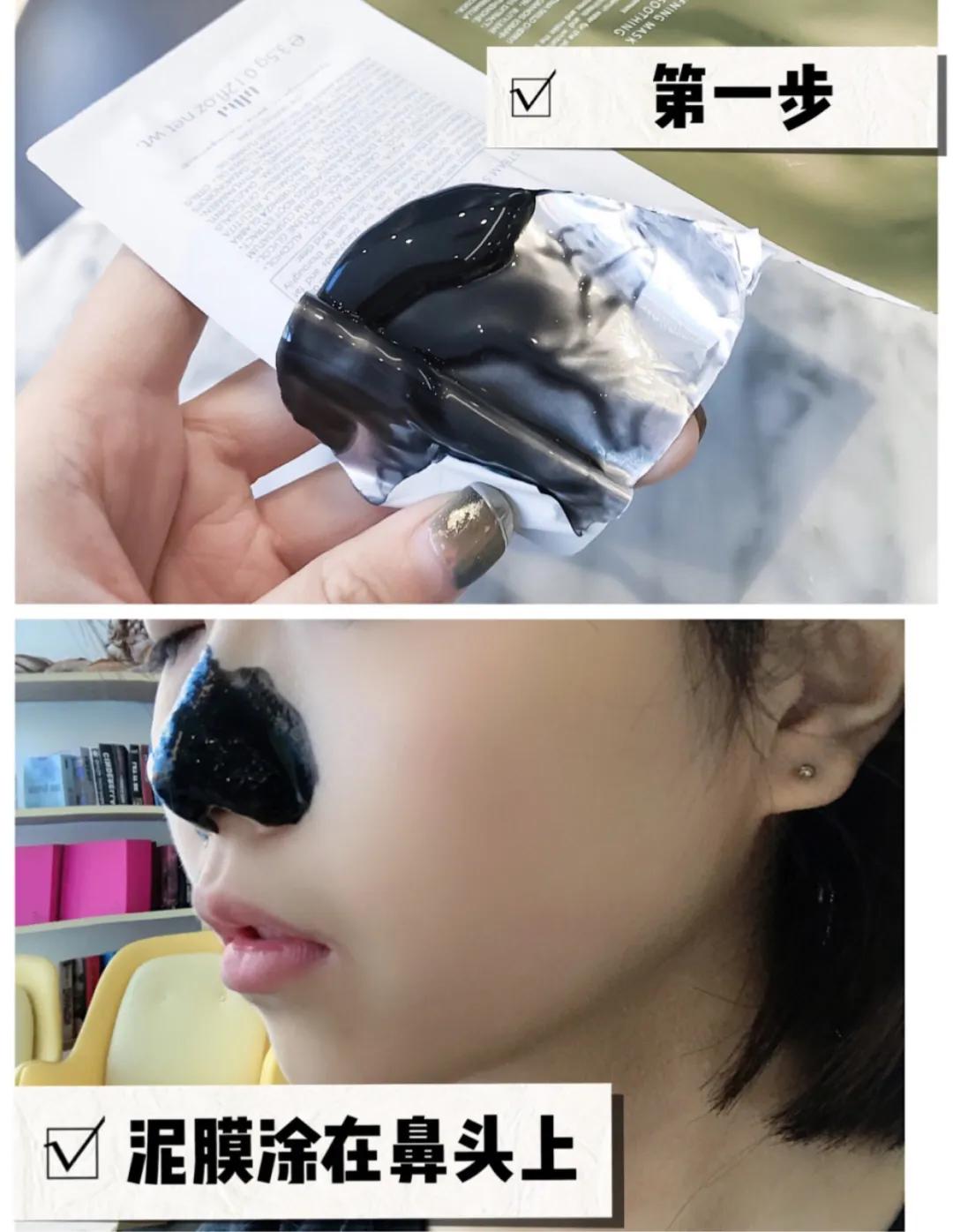 黑头闭口连根拔起,黑头粉刺连根拔起留坑