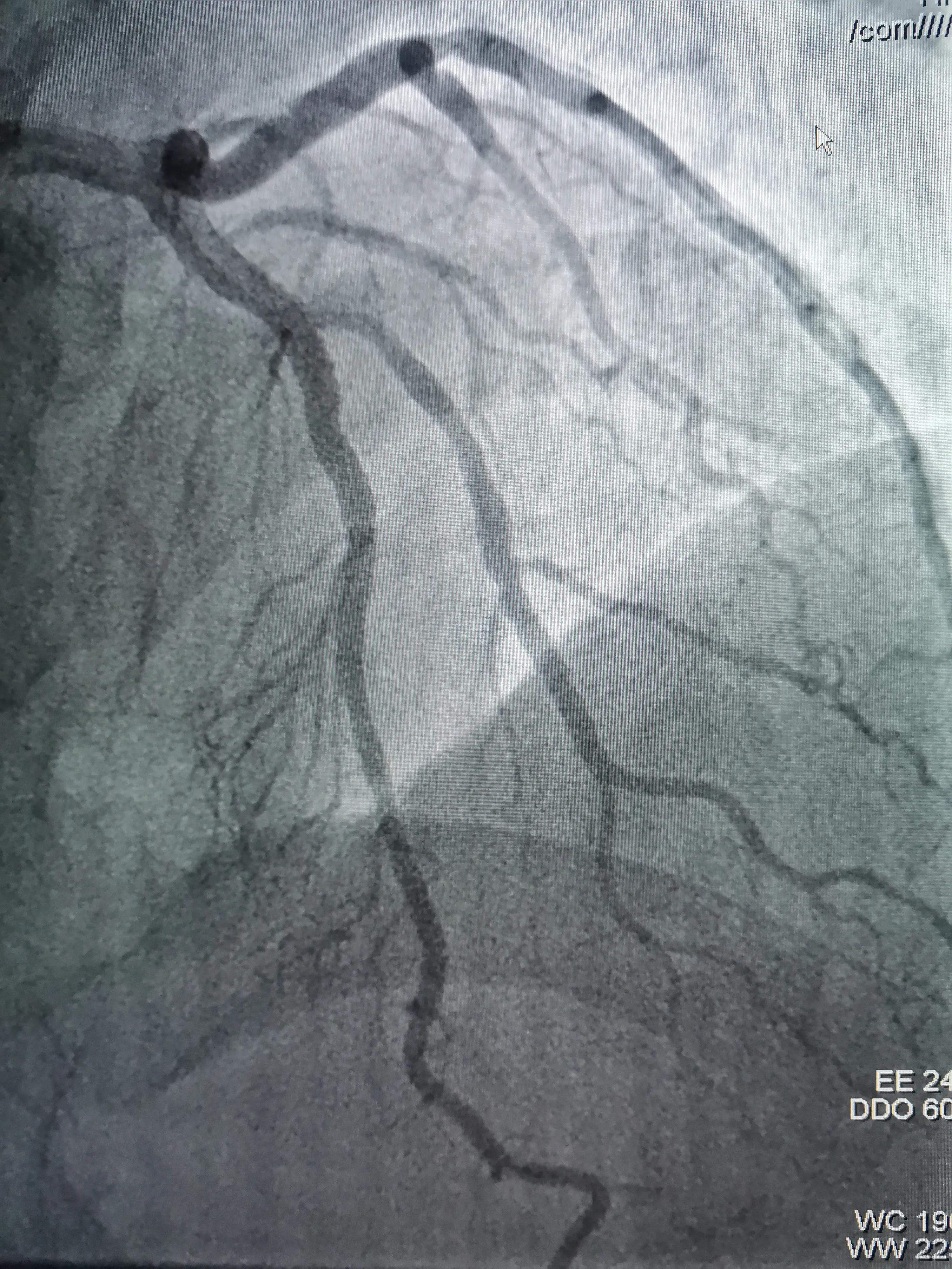 atp术式治疗冠脉分叉病变,冠脉分叉处堵塞能治吗