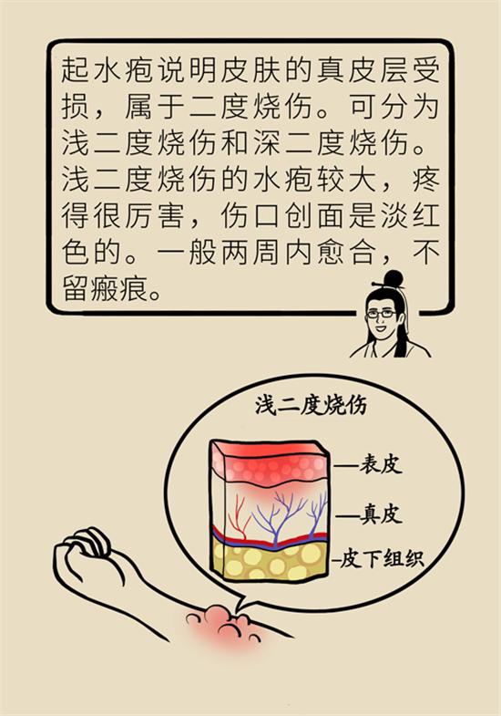 烫伤水泡如何换药,深2度烫伤换药总是有大水泡