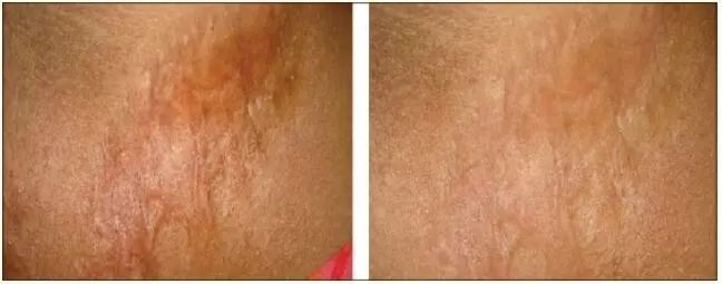 疤痕护理软膏可以修复疤痕吗,祛疤痕药能彻底祛疤吗