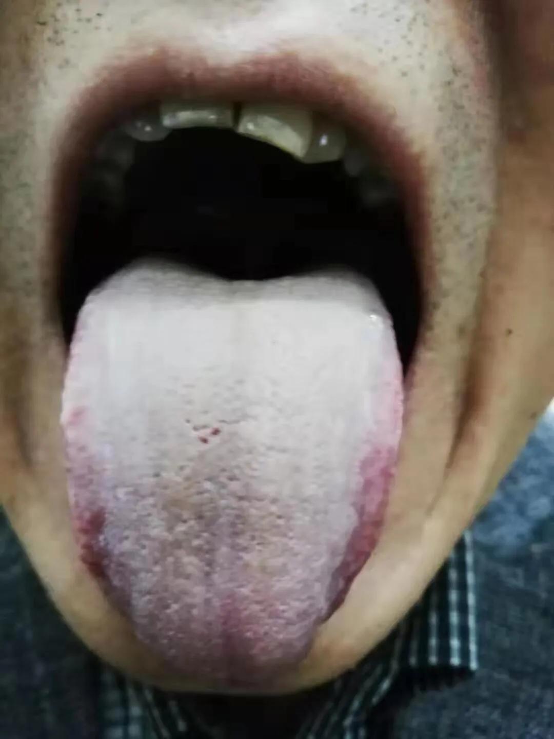 祛除湿气排湿气,如何治湿气