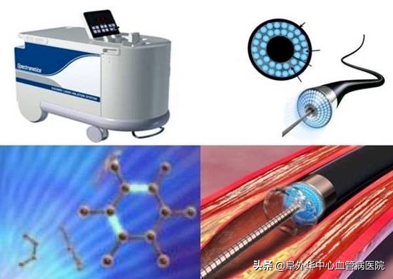 激光冠脉斑块消蚀术费用,冠脉介入手术去除冠脉钙化斑块吗