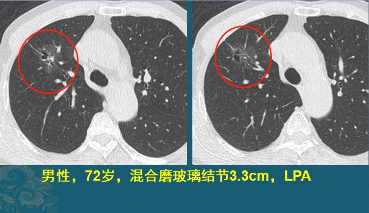 辟谣得了癌不治能活得更久,癌症能不能治医生说了大实话