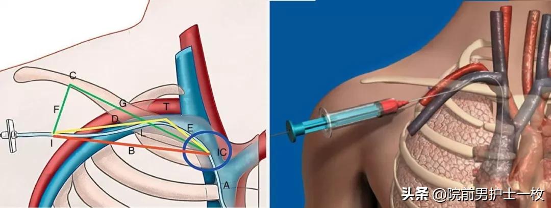 深静脉置管锁骨下静脉穿刺部位,深静脉穿刺置管拔出需要注意什么