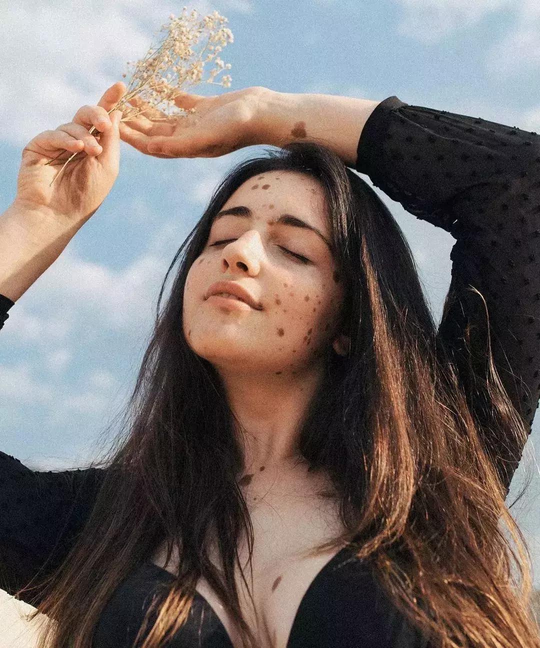 全身黑斑被骂“斑点狗”，身高160的她却成为最美超模…