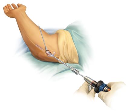 “医生,我胳膊肘伸不直了,还用不了筷子了,我是怎么了啊?”