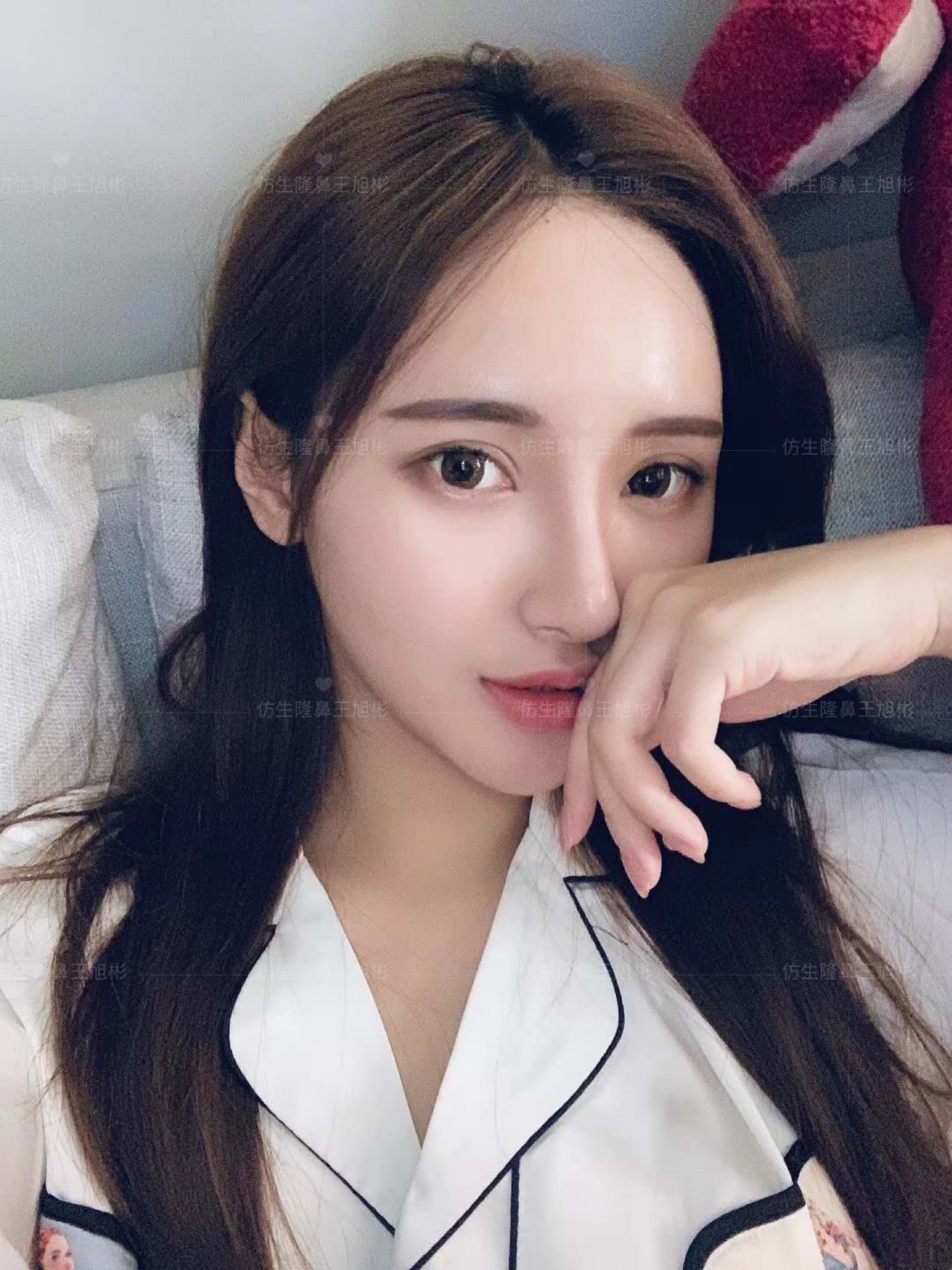 线雕隆鼻后鼻综合修复术,隆鼻失败修复手术真实案例