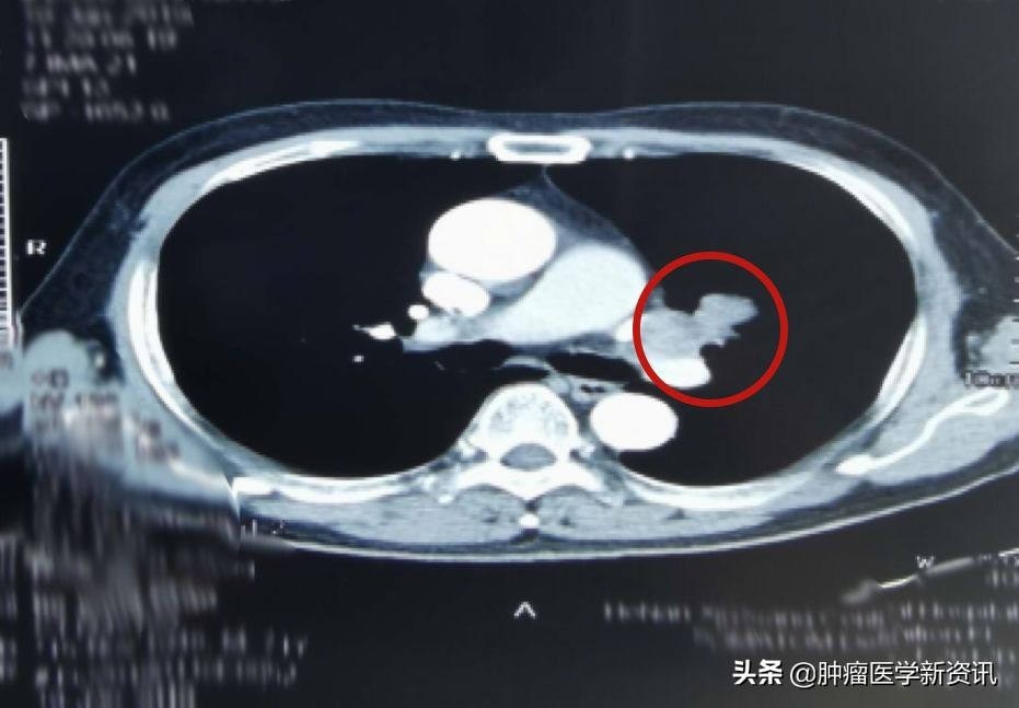肺癌早期的6个信号中医治癌,肺癌正确的抗癌方法