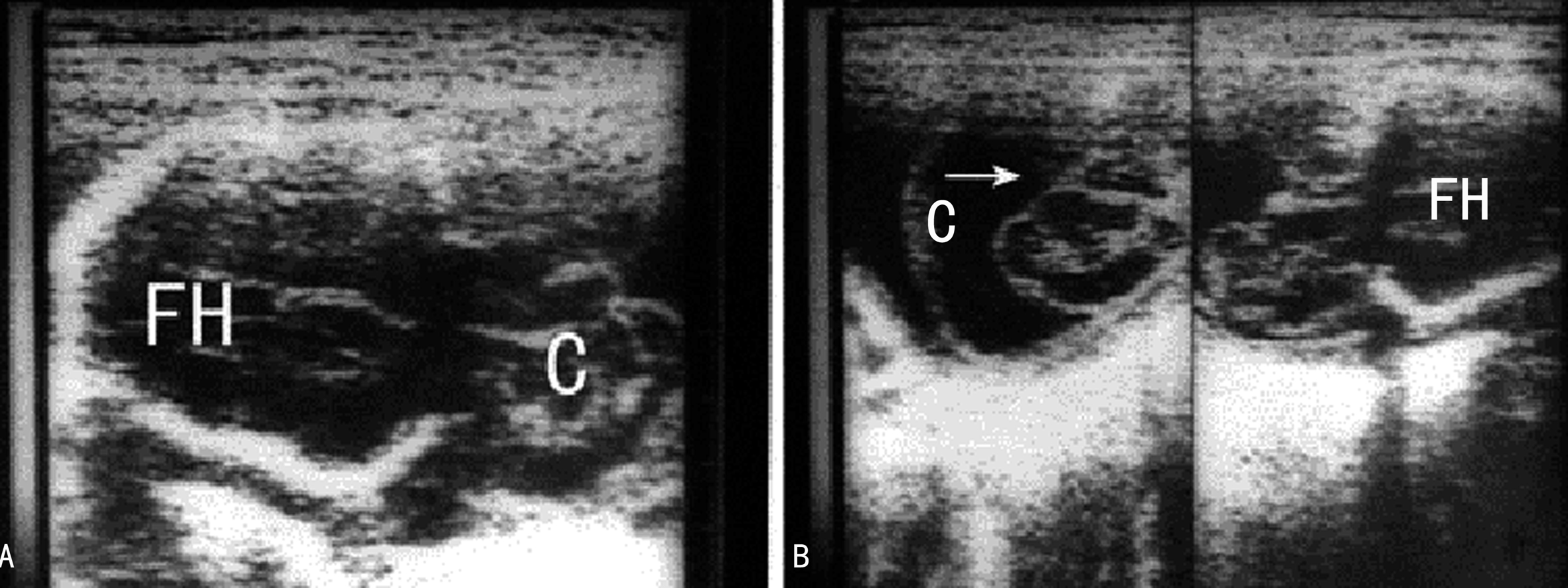 做普通彩超能不能看到胎儿侧脑室,超声胎儿针对性结构检查