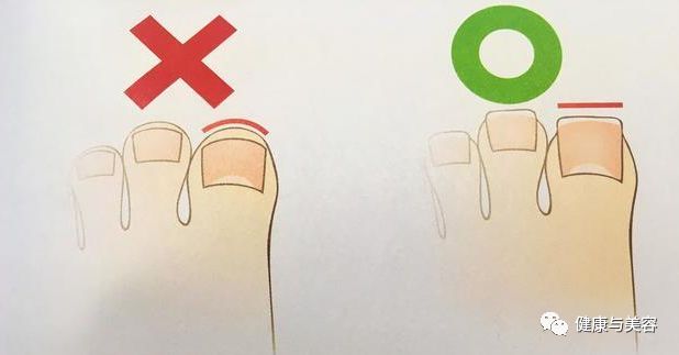 脚趾甲已经剪成圆形怎么办,脚趾甲长进肉怎么剪才不会痛