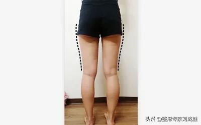 吸脂腿部的真实经历,腿部吸脂后悔者自述