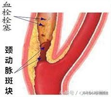 颈部动脉增厚怎么回事,颈部动脉有斑块会引起哪些危害