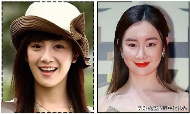 怎样填充太阳穴不显脸宽,怎样填充太阳穴和额头