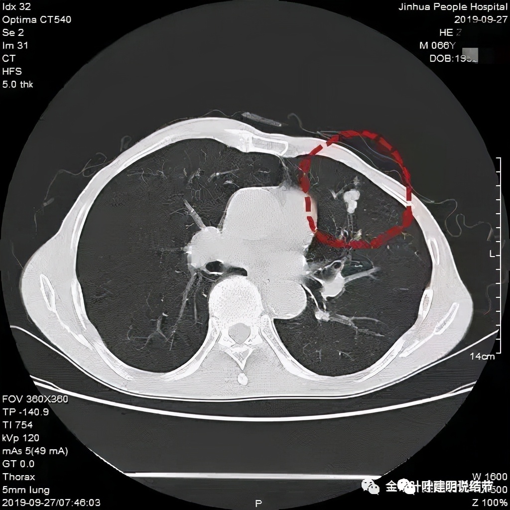 肺上有实性结节6mmx5mm是什么原因,肺上有1.7x1.8的实性结节该怎么办