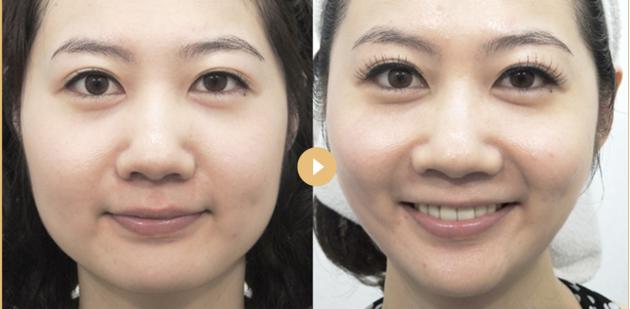 娃娃脸婴儿肥怎么瘦,怎么区分双下巴和婴儿肥