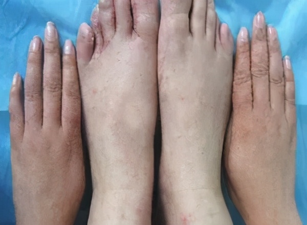 痒痒痒！身上出现这种小水疱，千万别戳破