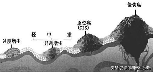 如果确认是原位癌需要手术切除么,肺结节原位癌早期手术可以痊愈吗