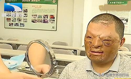 小伙被烧伤,小伙为救人烧伤毁容最后结果