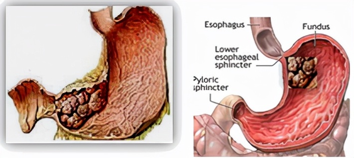 我不是药神,我不是财迷!若患胃癌,这些靶向药你有能力负担吗?