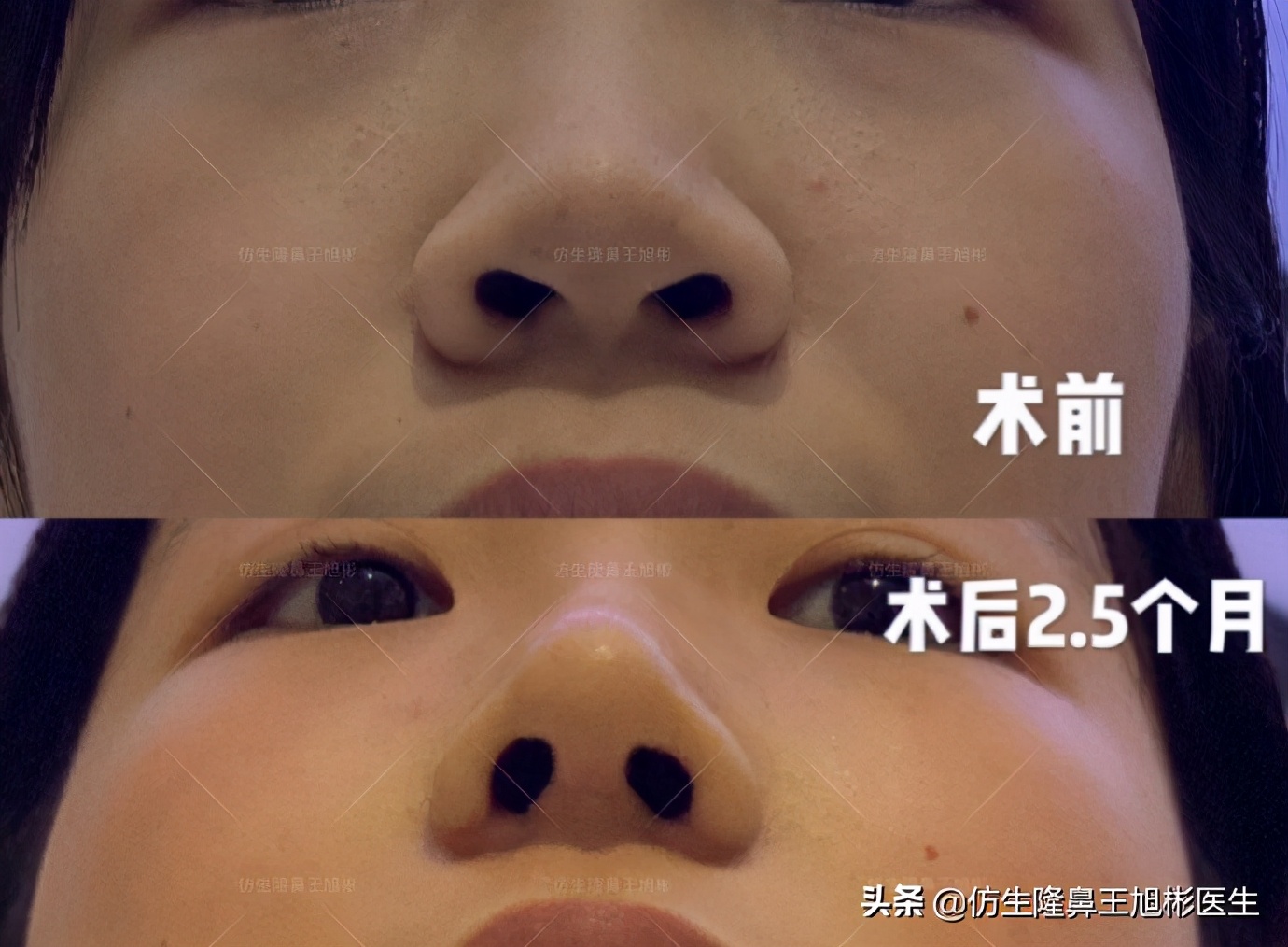 鼻头和鼻小柱是如何抬高的,鼻头扁是什么预兆