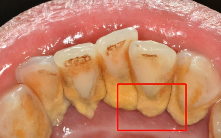 牙齿为什么会黑三角,牙齿出现黑三角是为什么