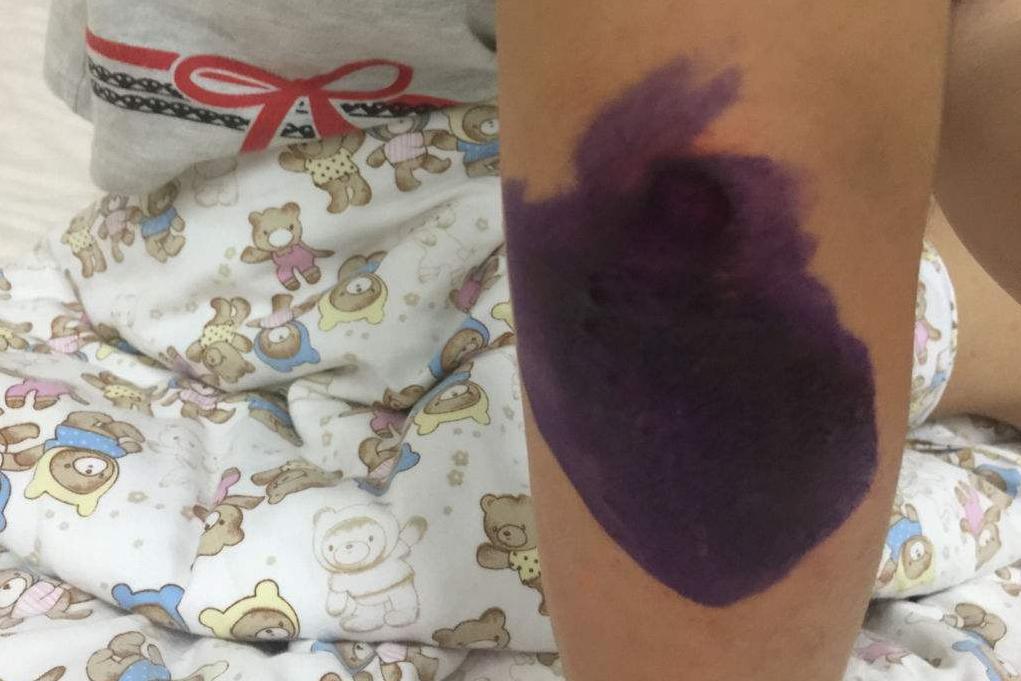 不小心擦破皮,怎么样处理才合适?分辨5个妙招,伤口不发炎