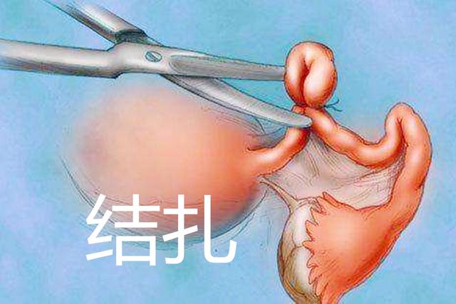 关于女性结扎,女的结扎是不是不可逆的