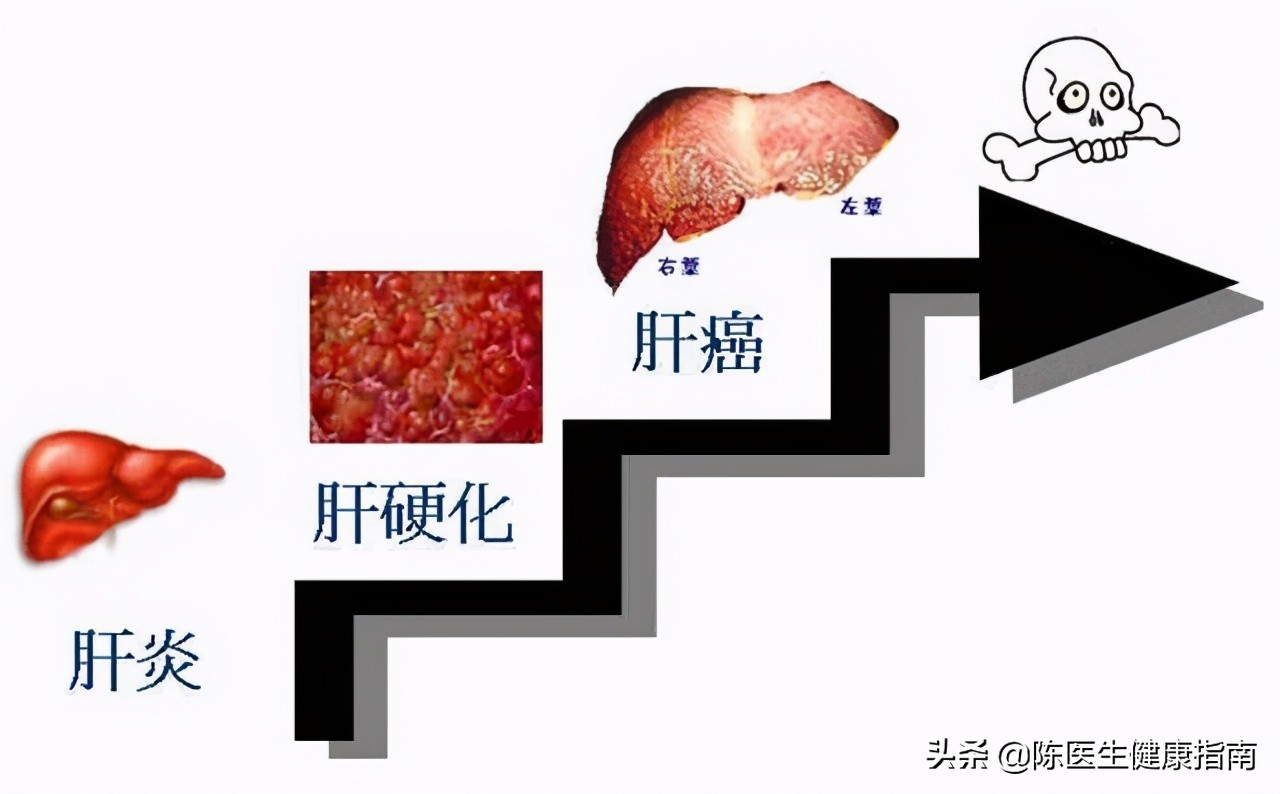 李兰娟院士:不要小看乙肝表面抗原的数值,它或可预测乙肝治愈率