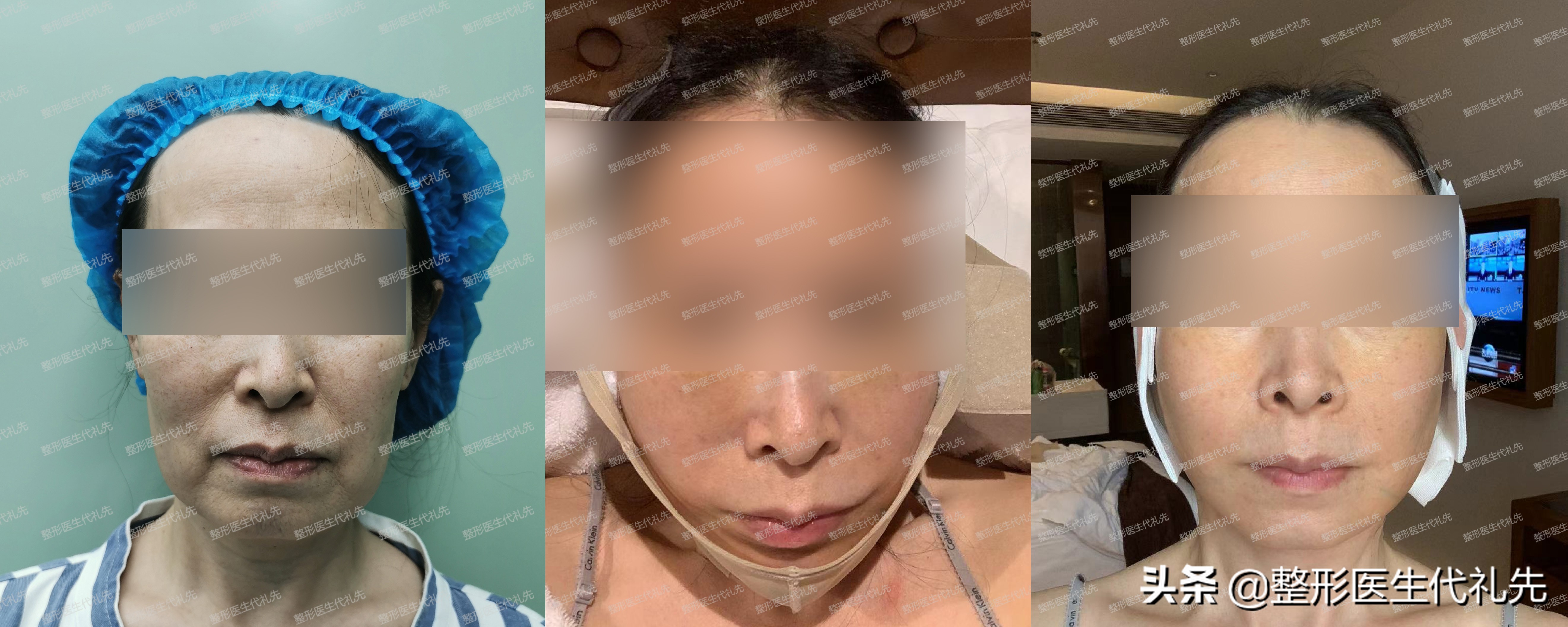 现在最流行的面部提升是什么项目,目前最先进效果最好的面部提升