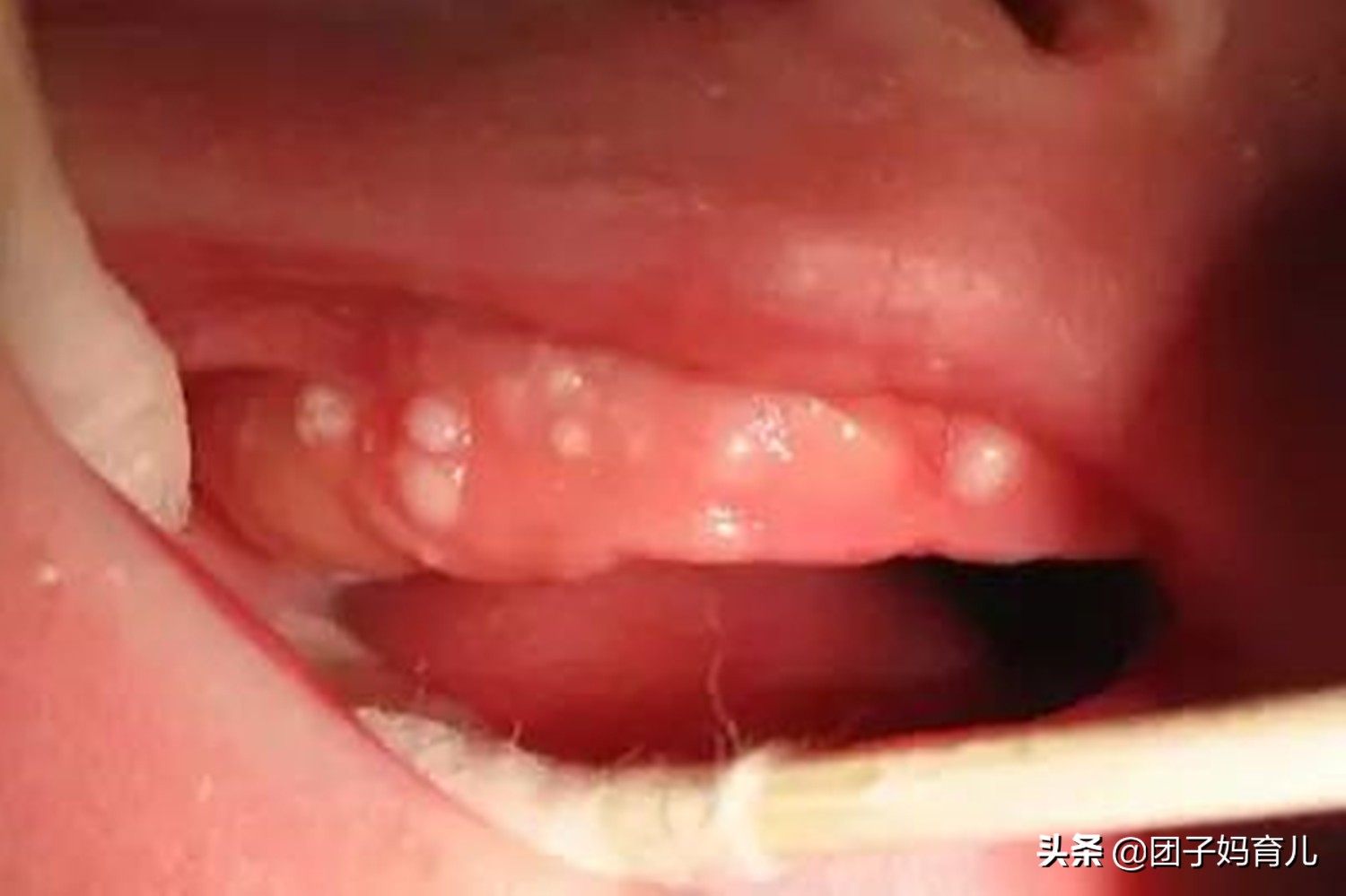 新生婴儿假性例假,新生儿来月经的症状