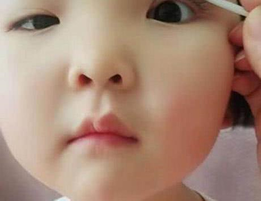 妈妈强行给1岁女儿割双眼皮,妈妈给割双眼皮
