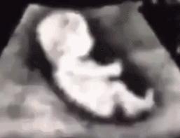 吃减肥药瘦后怀孕了,吃了减肥药怀孕胎儿会脑瘫吗