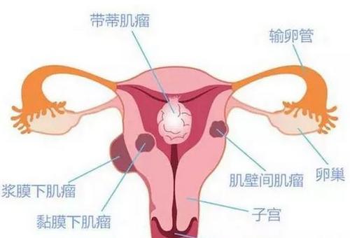 妇科炎症反复无常，究竟是什么原因造成的呢？