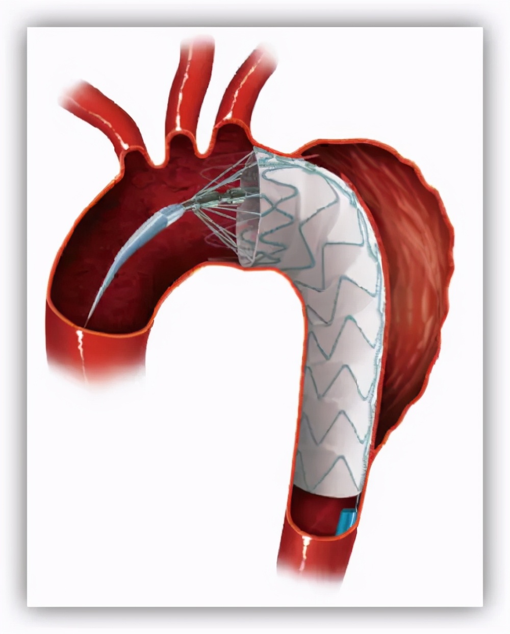 胸痛中心最常见的三种病,胸痛的四大杀手分别是什么