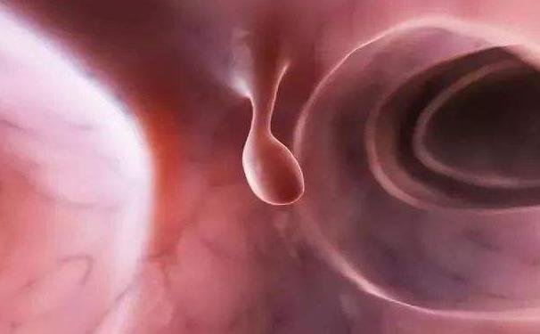 脾胃虚弱有息肉吃什么中成药,中医怎么治疗肠胃息肉