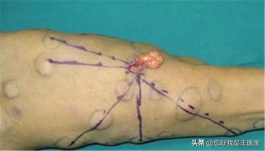 脂肪瘤如何消除？如何做到预防？