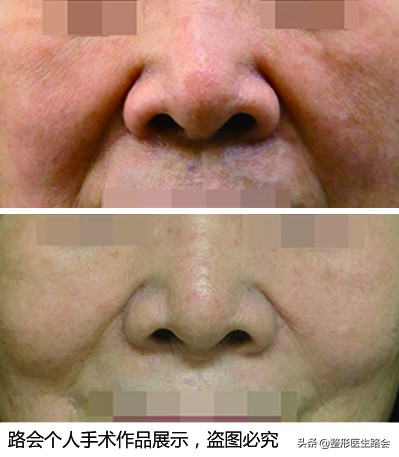 去除法令纹要先打苹果肌吗,去除法令纹可以打除皱针吗