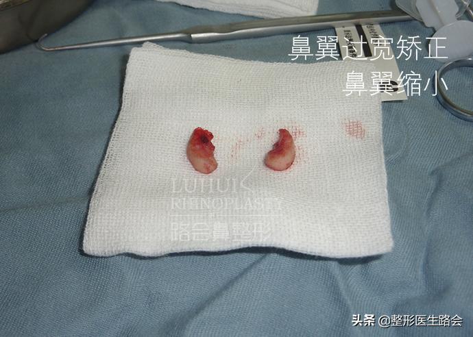 鼻翼缩小后期鼻头变宽,鼻翼变宽鼻头变大怎么改善
