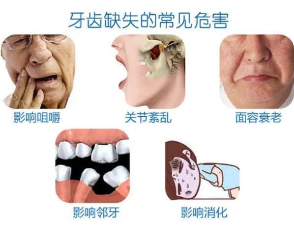 种植牙怎么知道自己种的什么品牌,种植牙选什么样的好